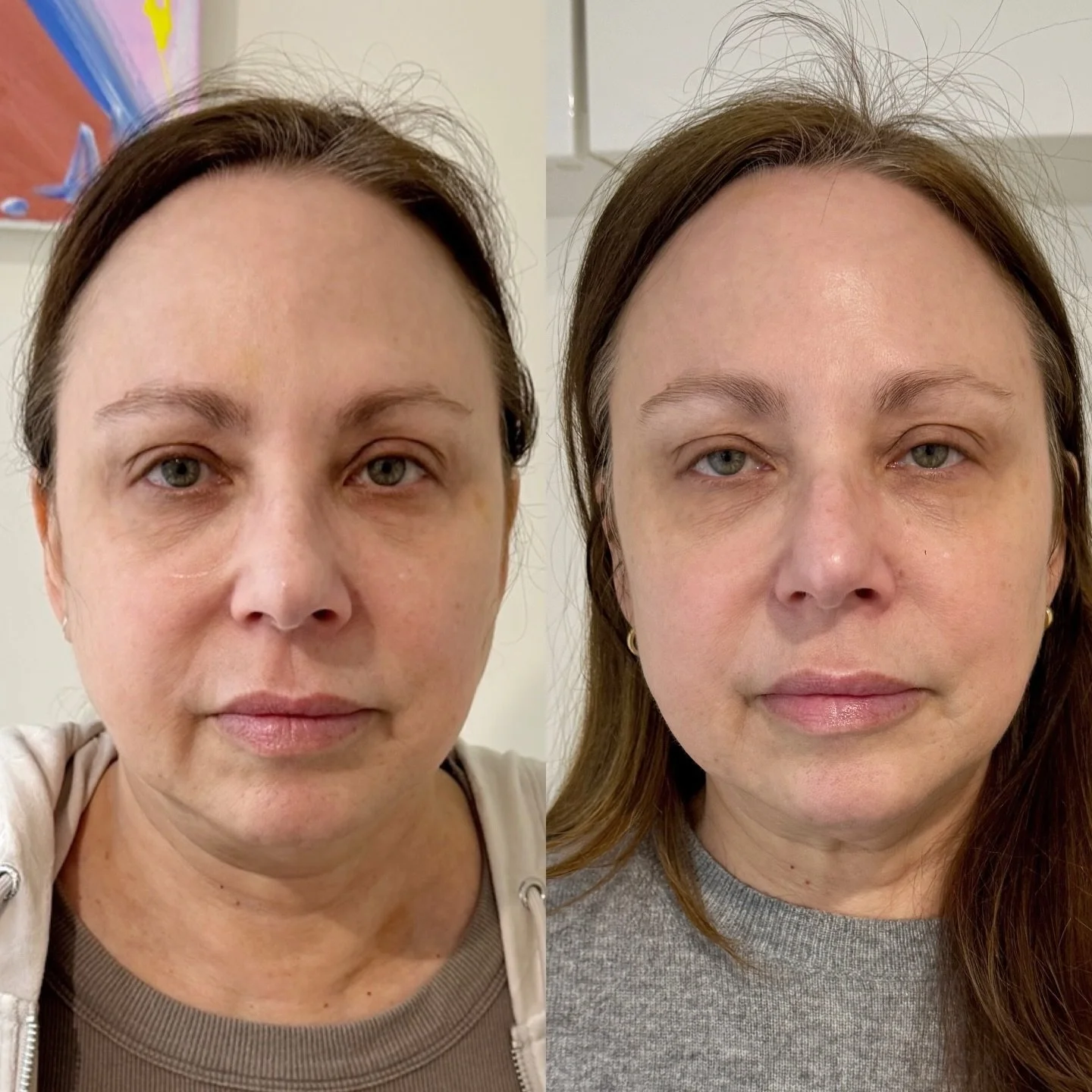 Real skin. Real results. ✨

This is after a series of CoolPeel CO₂ treatments on the right &mdash;no filters, no downtime drama. Just smoother texture, brighter tone, and that subtle tightening we all love.

CoolPeel works by delivering controlled CO
