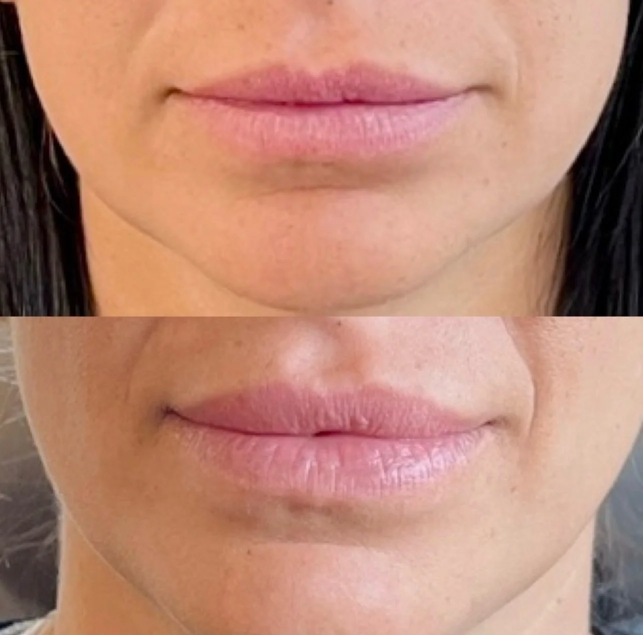 Subtle volume + a lifted shape = the perfect balance 💉✨
A lip filler + lip flip combo enhances your natural lips by adding structure, improving symmetry, and gently turning the lips upward for that soft, effortless &ldquo;at rest&rdquo; pout.

No ov