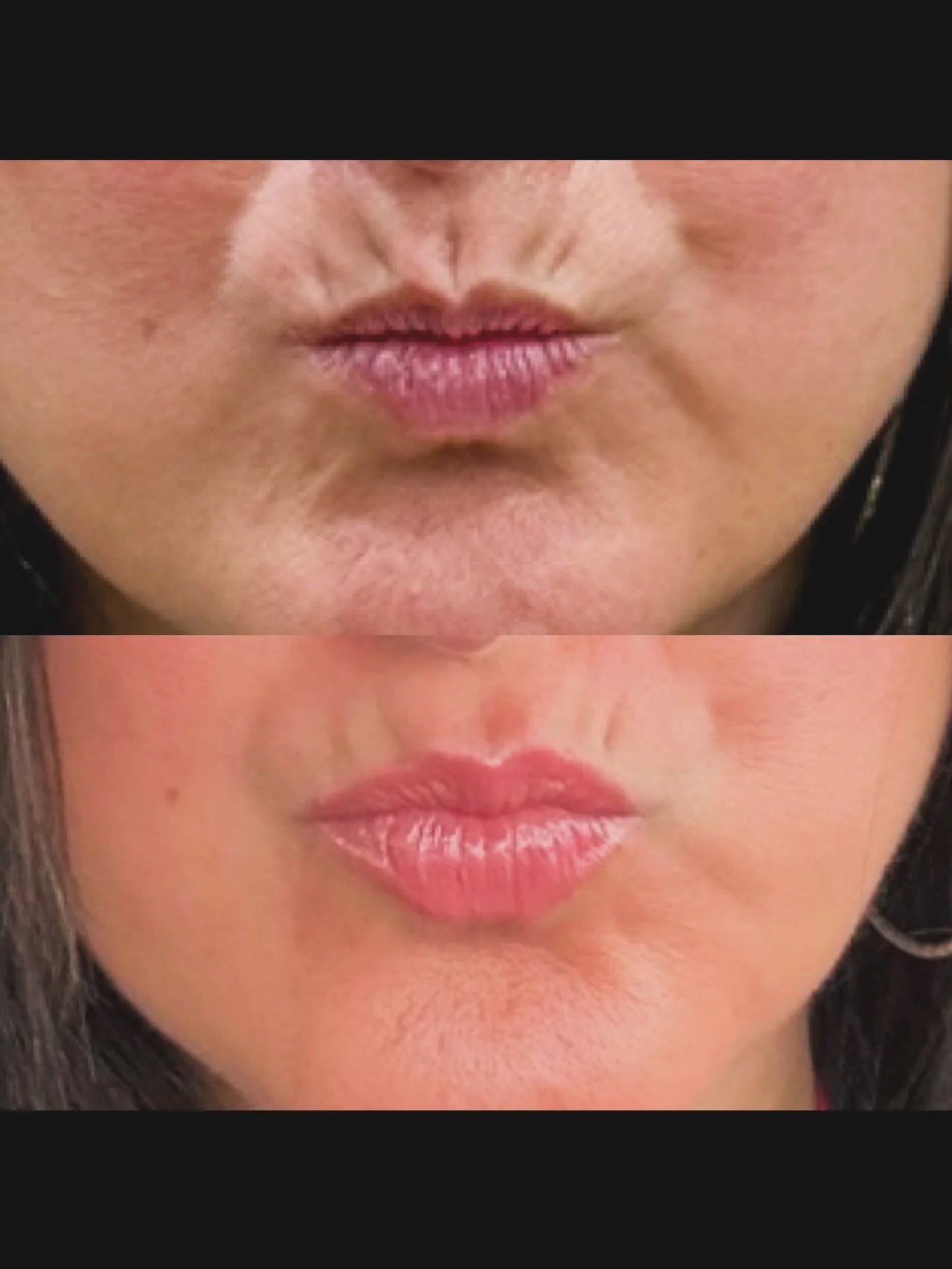 From tension &rarr; to smooth, balanced, and lifted 💉✨

Lower face neurotoxin can soften the muscles that cause puckering, chin dimpling, and downward pull around the mouth. By relaxing these areas, we create a more effortless, relaxed appearance&md