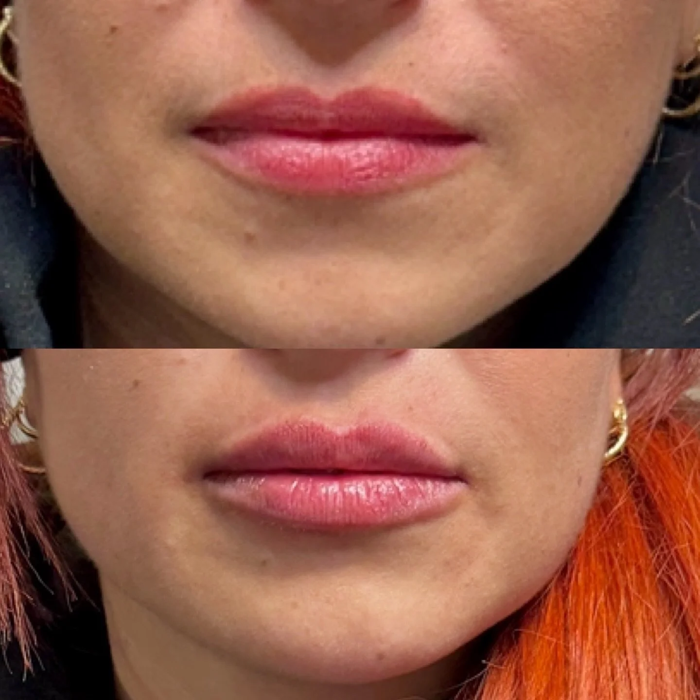 Subtle, balanced, and beautifully hydrated 💋
A touch of volume + refined shaping to enhance&mdash;not change&mdash;your natural lips. This is what intentional, medical-grade artistry looks like.

Soft definition. Improved symmetry. Effortless confid