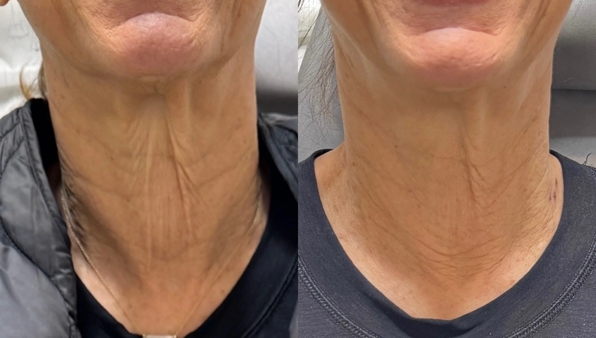 Your face may look youthful&mdash;but the neck often tells the real story.

This beautiful result was achieved using a combination of neurotoxin, cool peel laser and filler to:

* Relax prominent platysmal bands
* Soften horizontal neck lines
* Impro