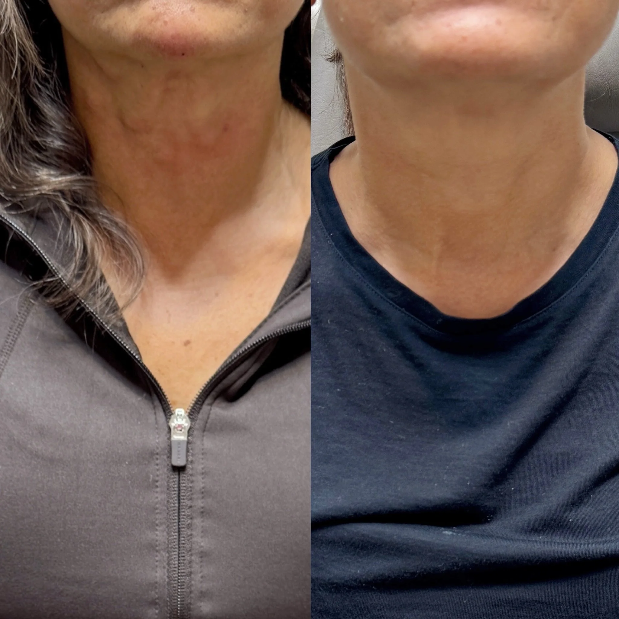 The neck is one of the first areas to show aging.

This result was achieved using a combination of neurotoxin and filler to soften platysmal bands, improve neck lines, and restore a smoother, more youthful appearance.

No surgery. Natural-looking res