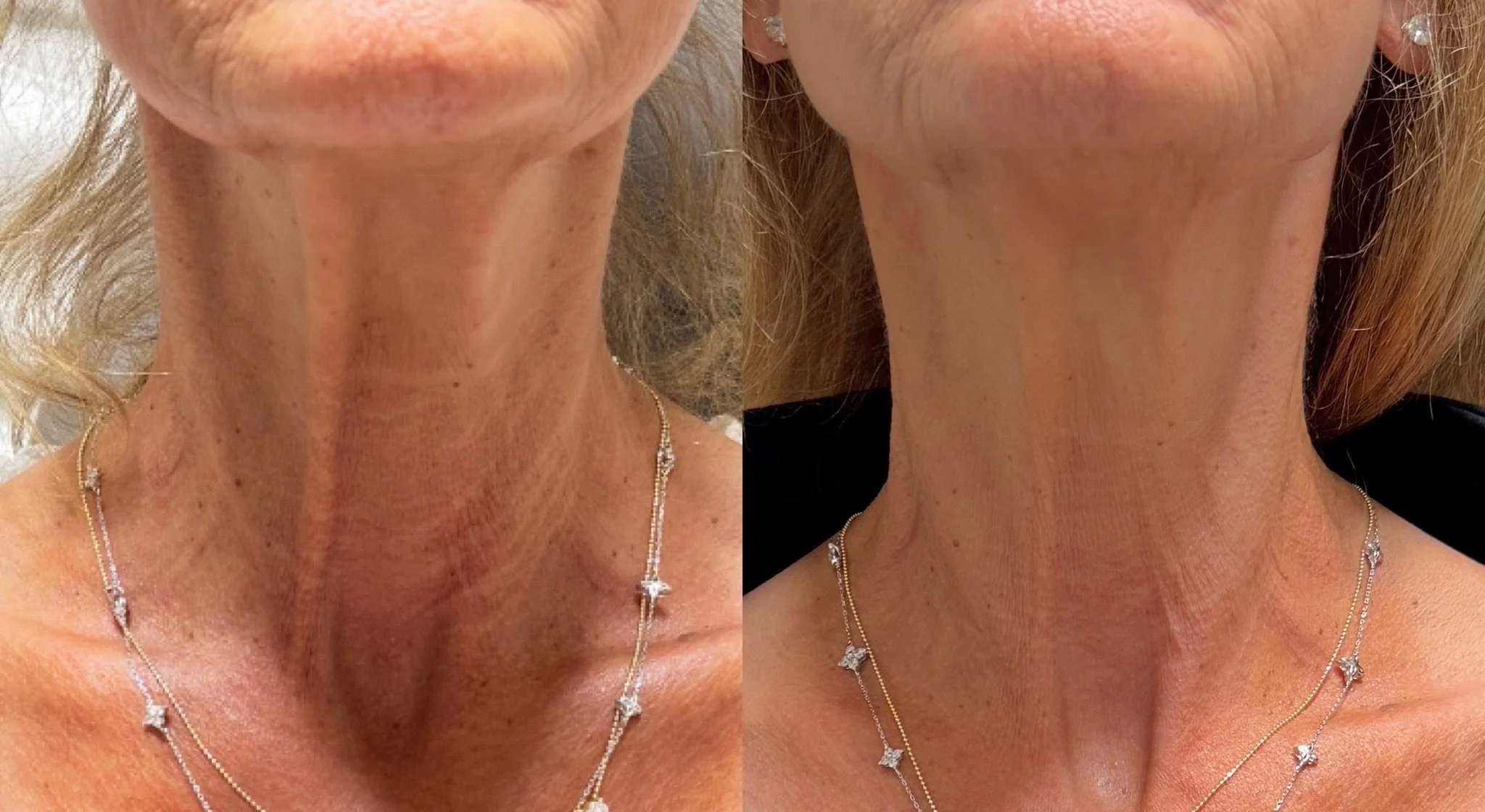Neurotoxin + filler to the neck ✨

A customized combination treatment designed to soften horizontal lines, improve skin texture, smooth creasing, and create a firmer, tighter appearance of the neck and lower face. Small details can make a huge differ