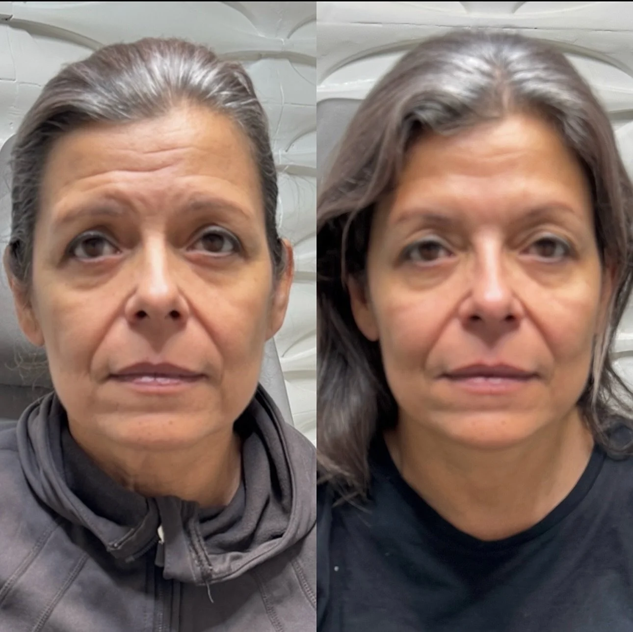 Less tired. More refreshed. ✨

Strategic filler and neurotoxin placement helped restore volume, soften lines, and brighten the overall appearance while maintaining natural facial expression.

The goal is never to look different&mdash;it&rsquo;s to lo