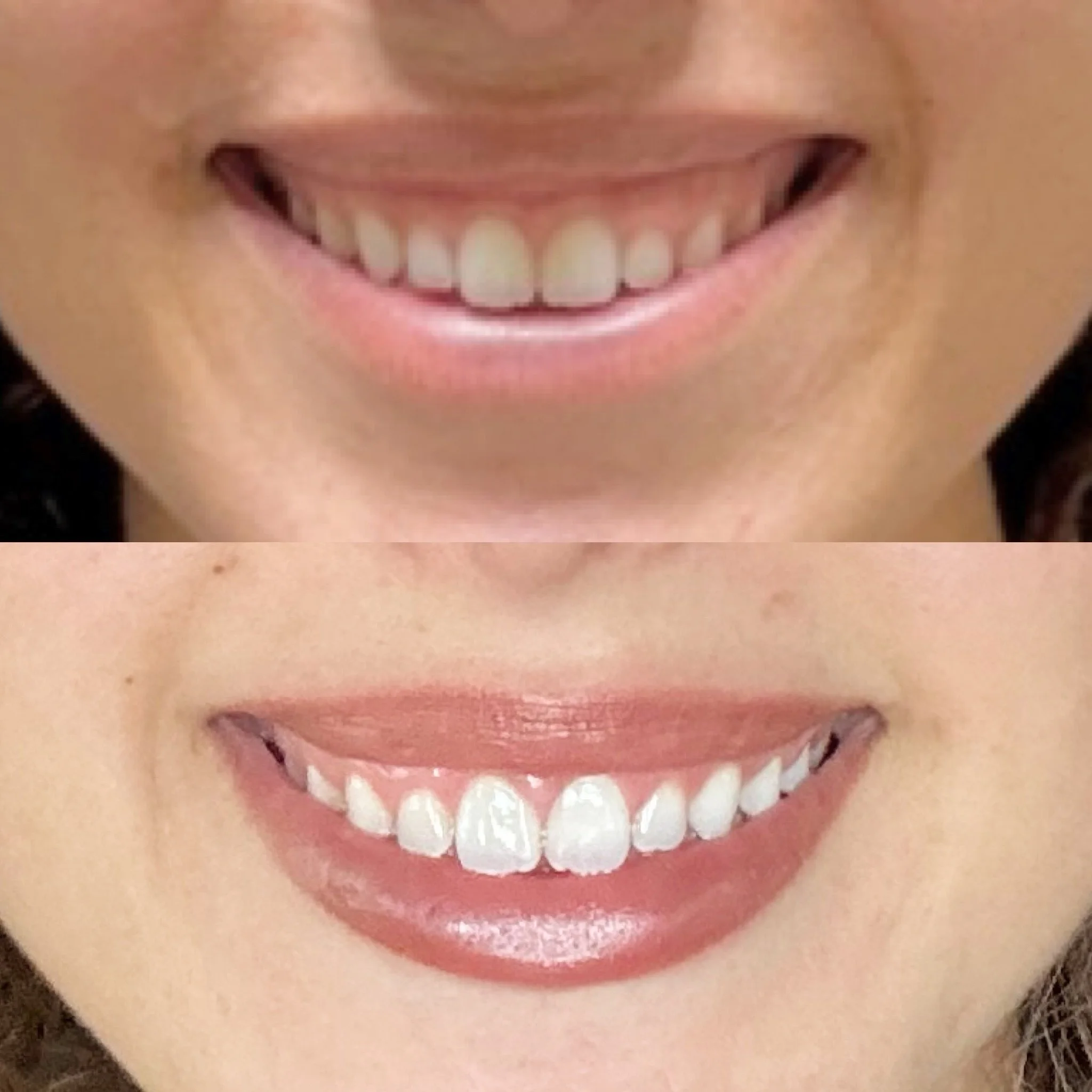 👄✨ Gummy Smile Correction with Neurotoxin ✨👄

Sometimes a beautiful smile shows a little more gum tissue than you&rsquo;d like. The good news? A quick, minimally invasive treatment with neurotoxin can help relax the muscles that elevate the upper l