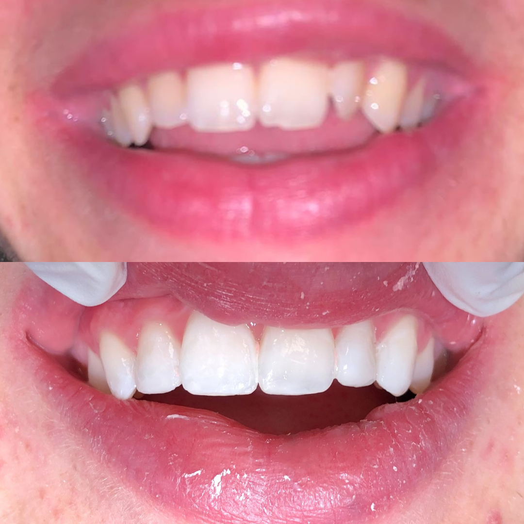 Teeth Whitening 1.png