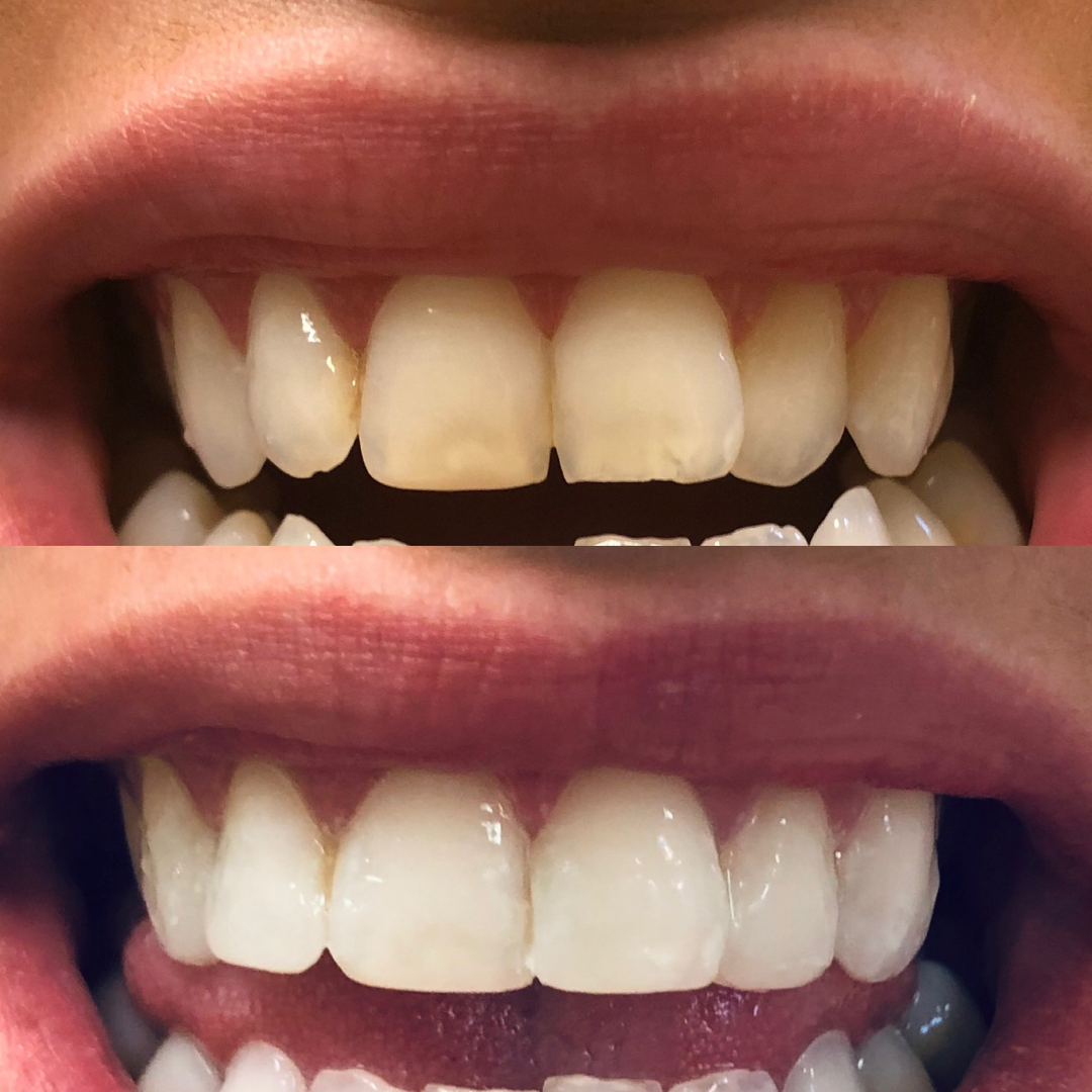 Teeth Whitening 2.png
