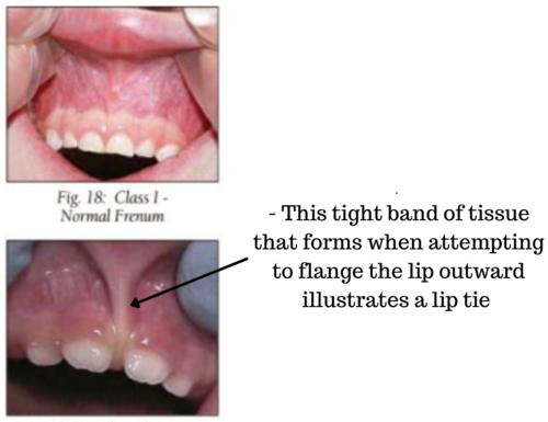 What Exactly A Lip Tie Is?