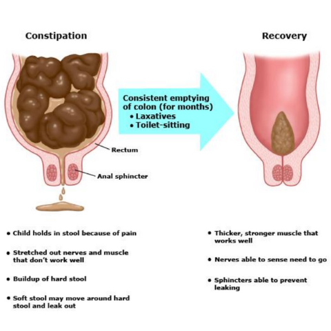 Diagram showing how stool withholding stretches the rectum and leads to encopresis