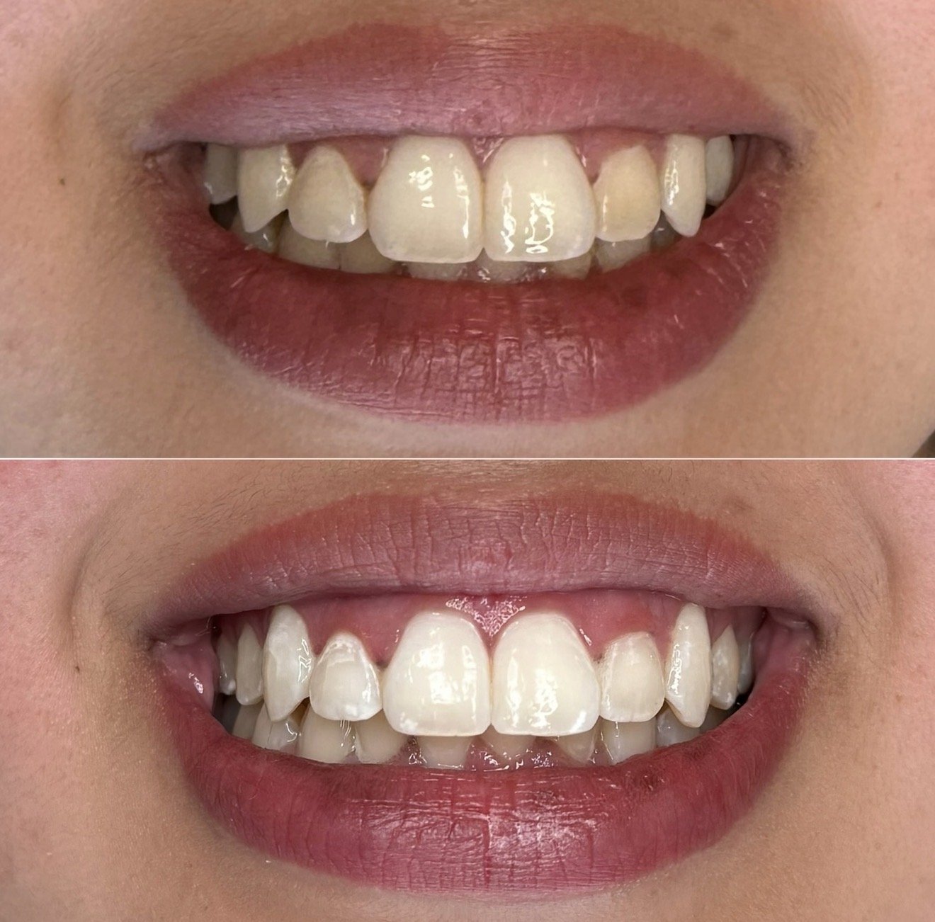 TEETH WHITENING