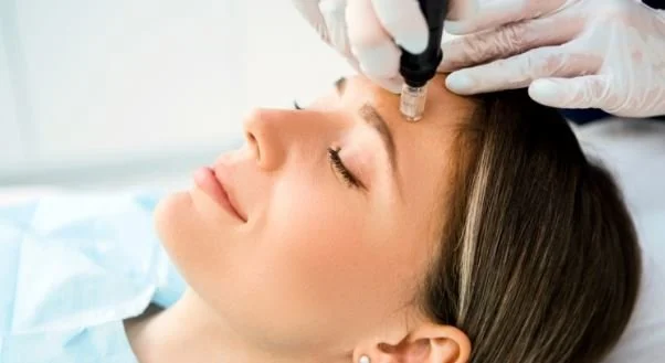 microneedling.JPG