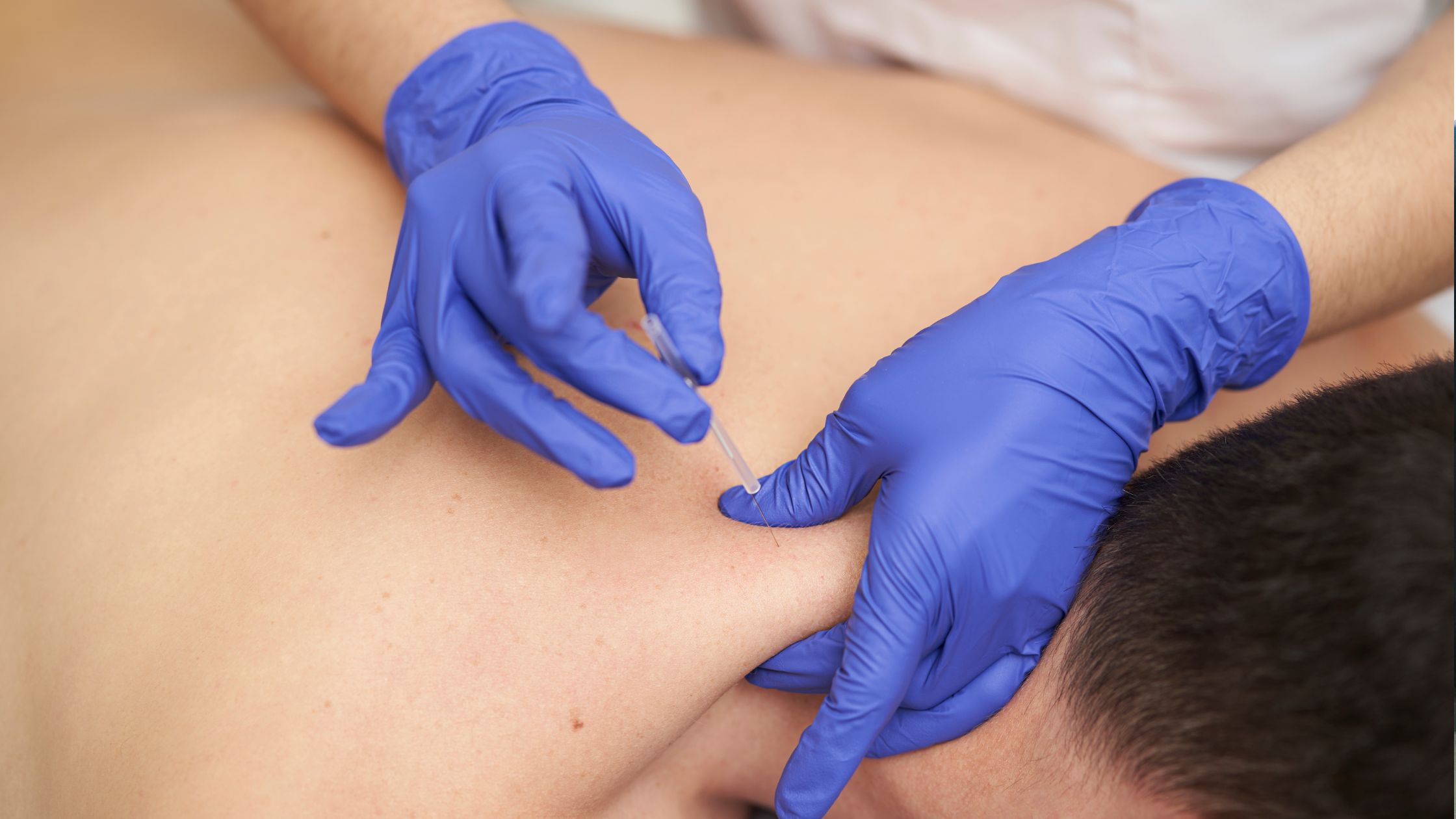 Everything you need to know about dry needling