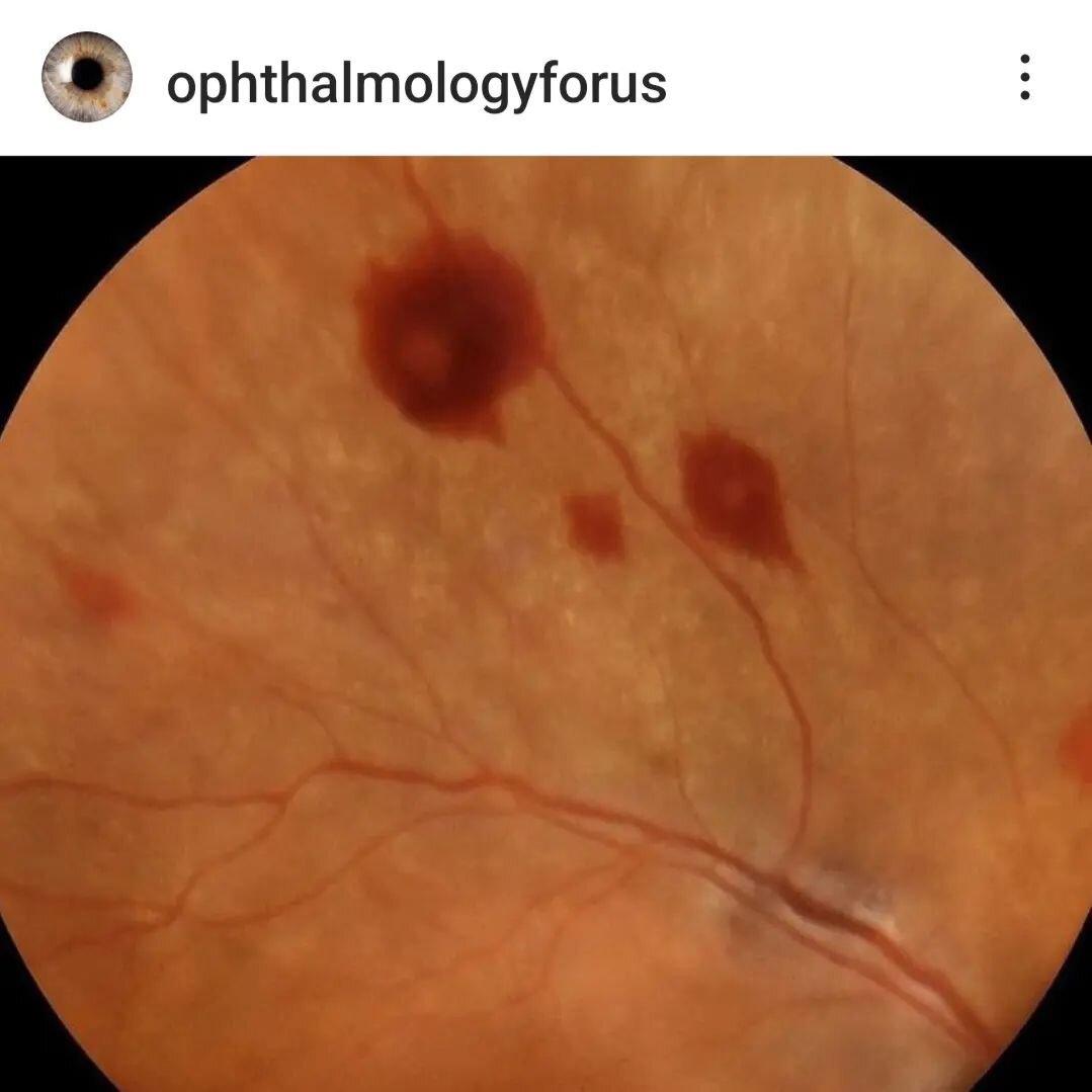 &Ccedil;ok tipik olan bu fotoğrafı paylaşmak istedim.
@ophthalmologyforus 
%80 oranında bakteriyel endokardit (kalp i&ccedil; y&uuml;zeyi ve kapaklarının mikrobik iltihabı) durumunda g&ouml;r&uuml;len Roth lekeleri.
Diabet, hipertansiyon, kansızlık v