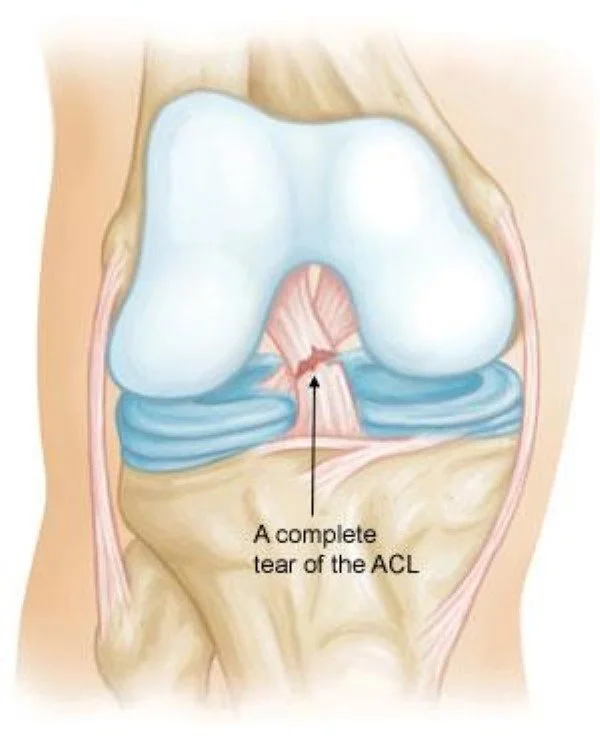 ACL Grafts: Autografts in detail
