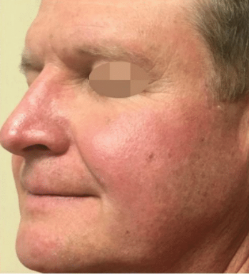 After Alma Harmony™ Laser equipped with the Iris Dye-VL handpiece