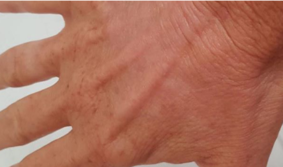 After Alma Harmony™ Laser equipped with the Iris Dye-VL handpiece