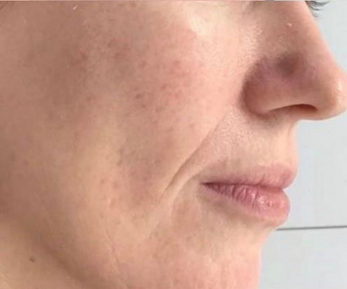 After Alma Harmony™ Laser equipped with the Iris Dye-VL handpiece