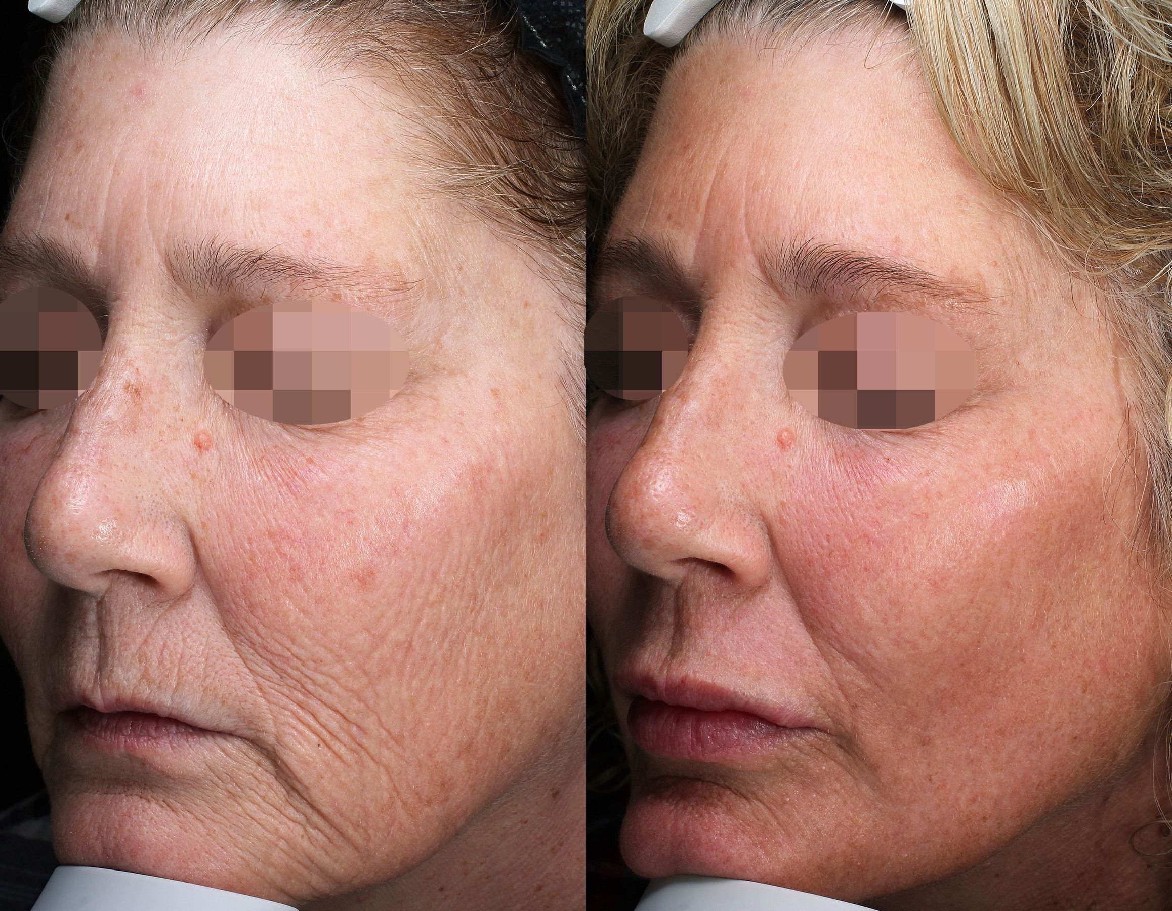 Before &amp; After Alma Hybrid™ Laser