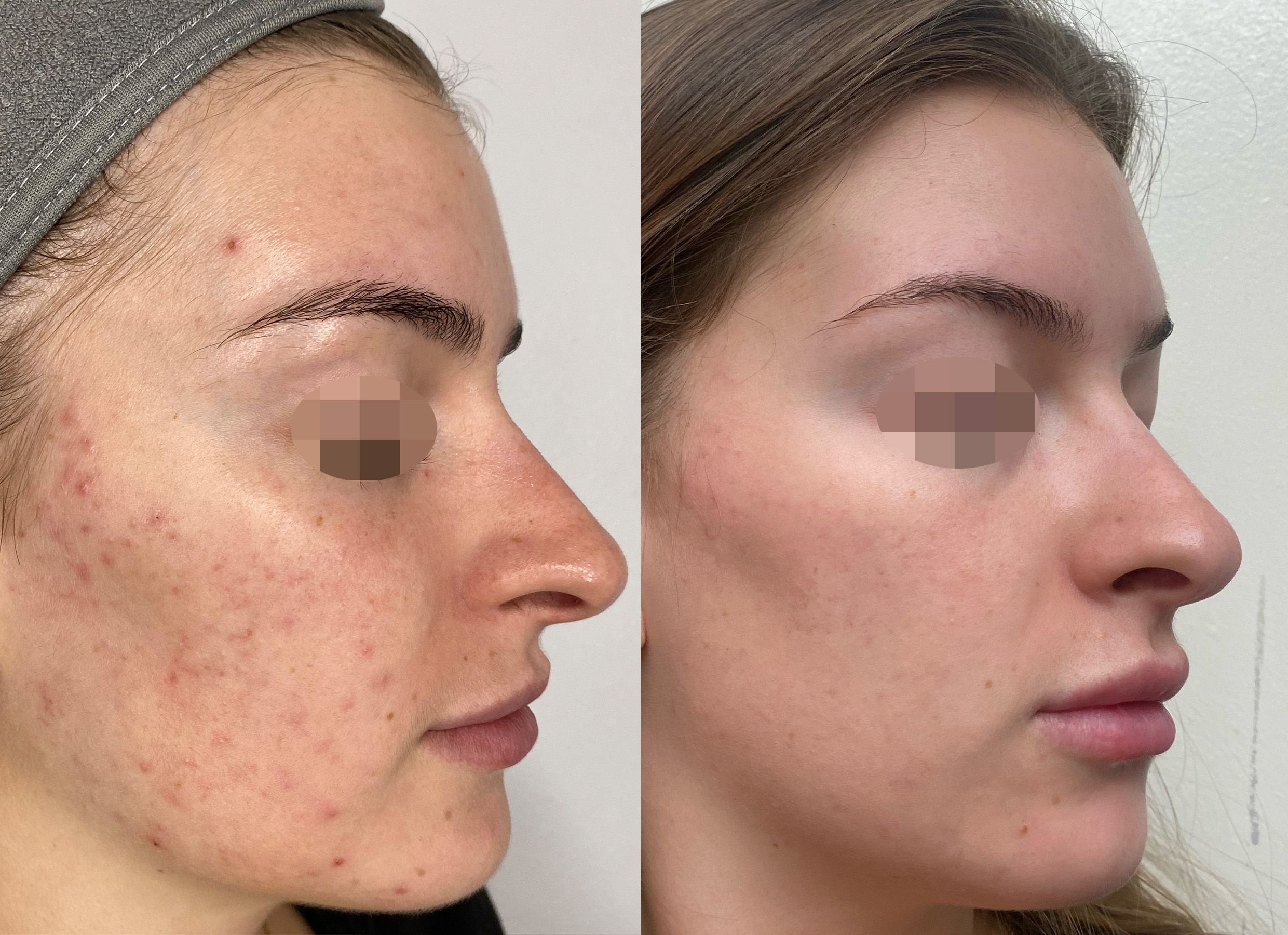 Before &amp; After Alma Hybrid™ Laser