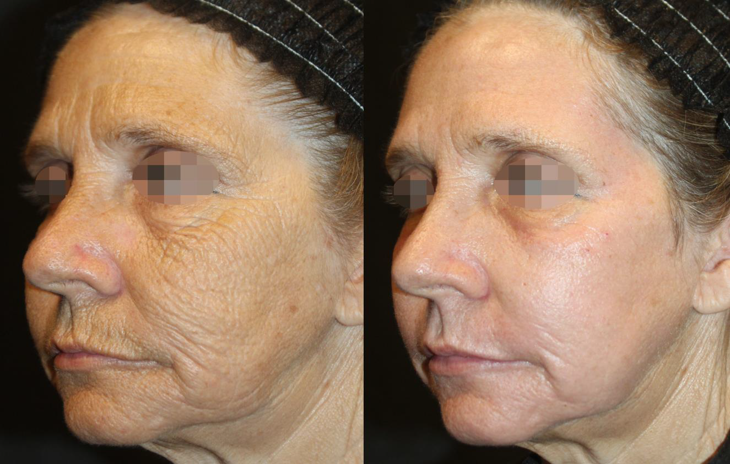Before &amp; After Alma Hybrid™ Laser
