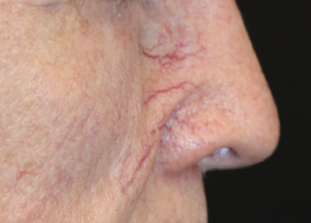 Alma Harmony ClearLift Before Photo