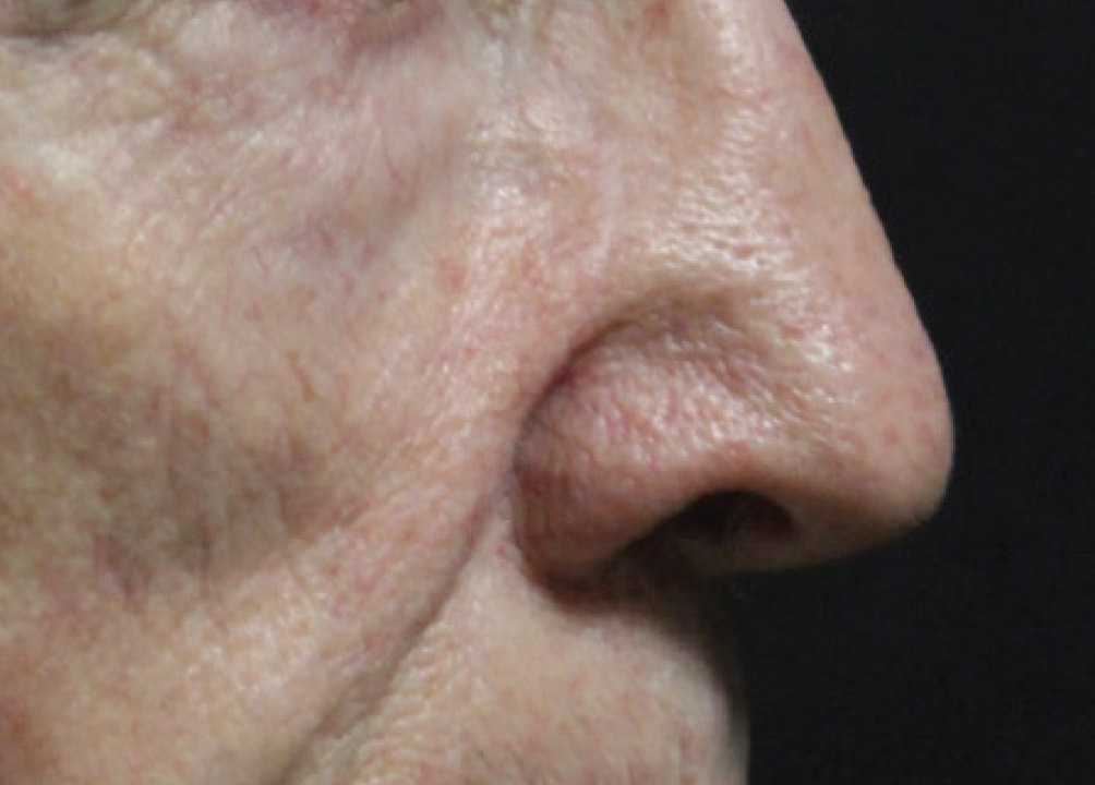 Alma Harmony ClearLift After Photo