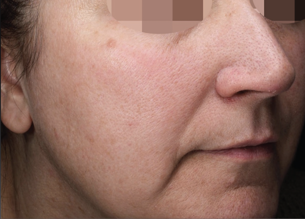 Alma Harmony ClearLift After Photo