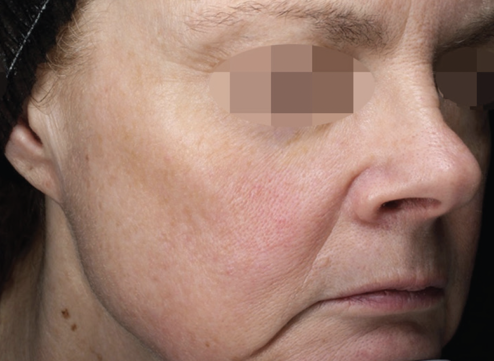 Alma Harmony ClearLift After Photo