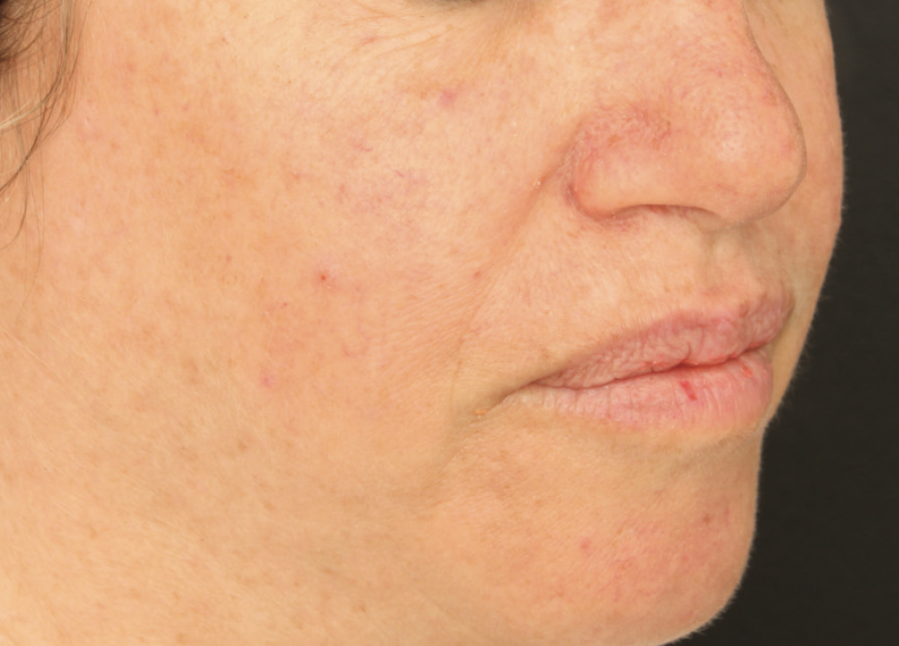 Alma Harmony ClearLift After Photo