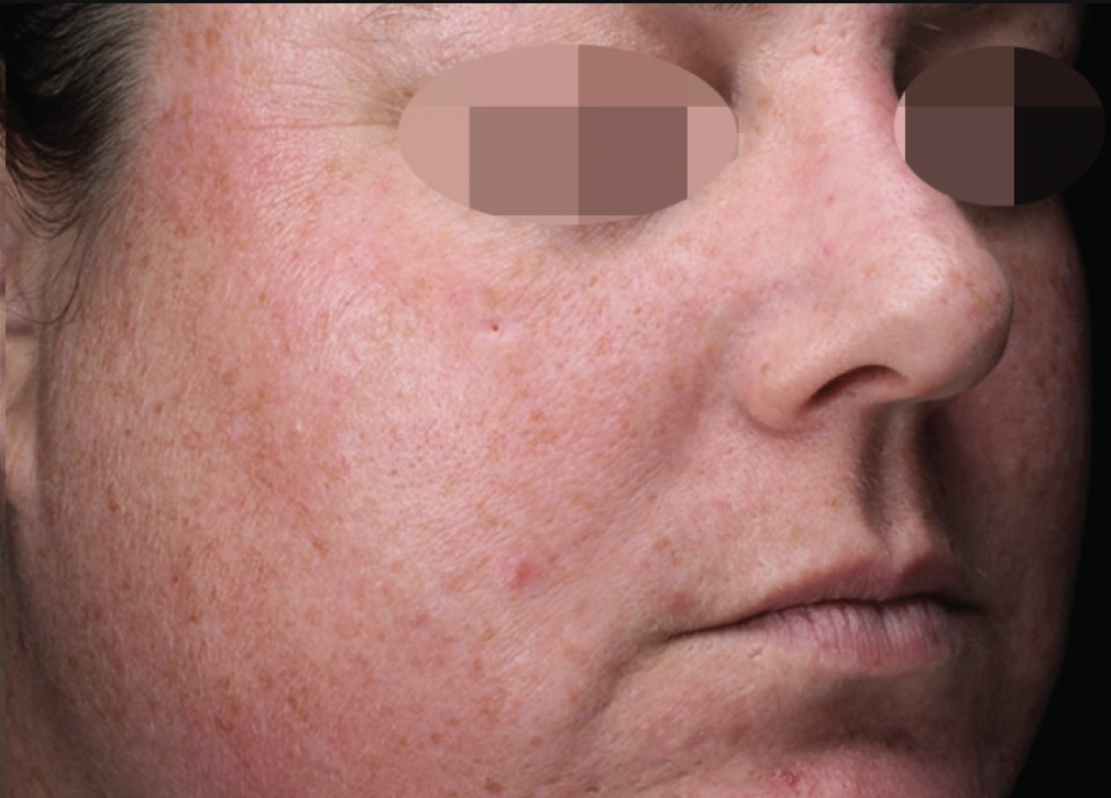 Alma Harmony ClearLift Before Photo