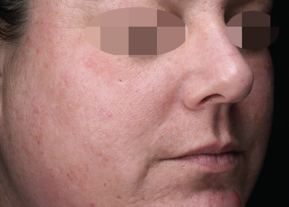 Alma Harmony ClearLift After Photo