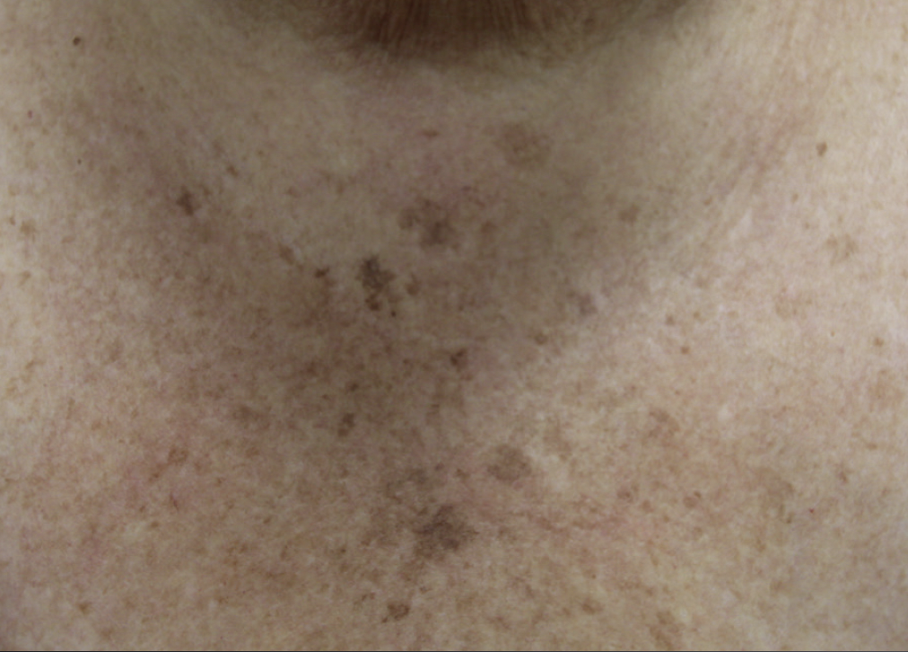 Alma Harmony ClearLift Before Photo