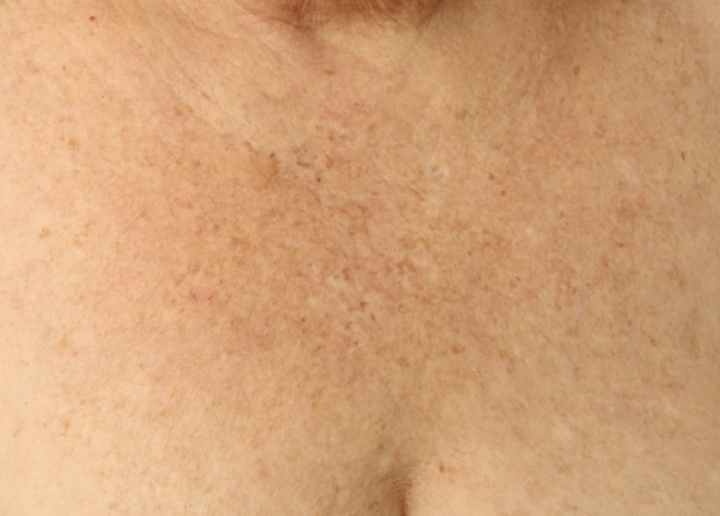Alma Harmony ClearLift After Photo