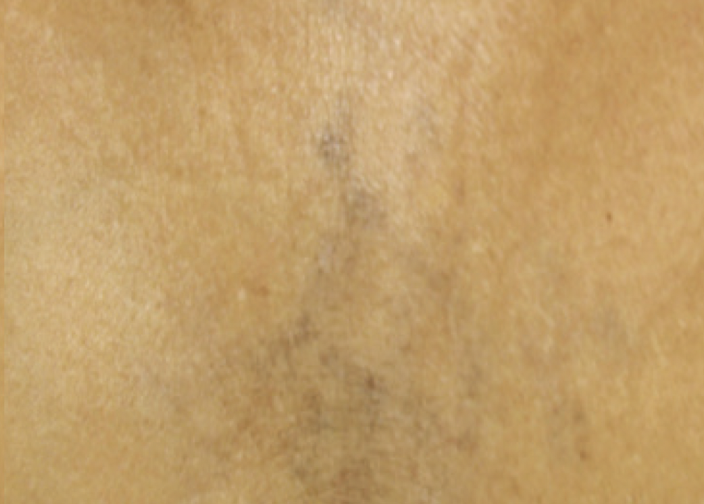 Alma Harmony ClearLift After Photo