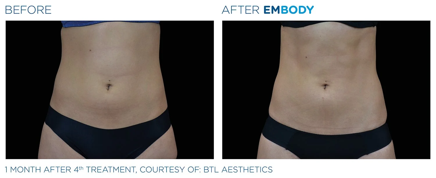 EMBODY Abdomen Before and After Results | JBH Aesthetics Camden