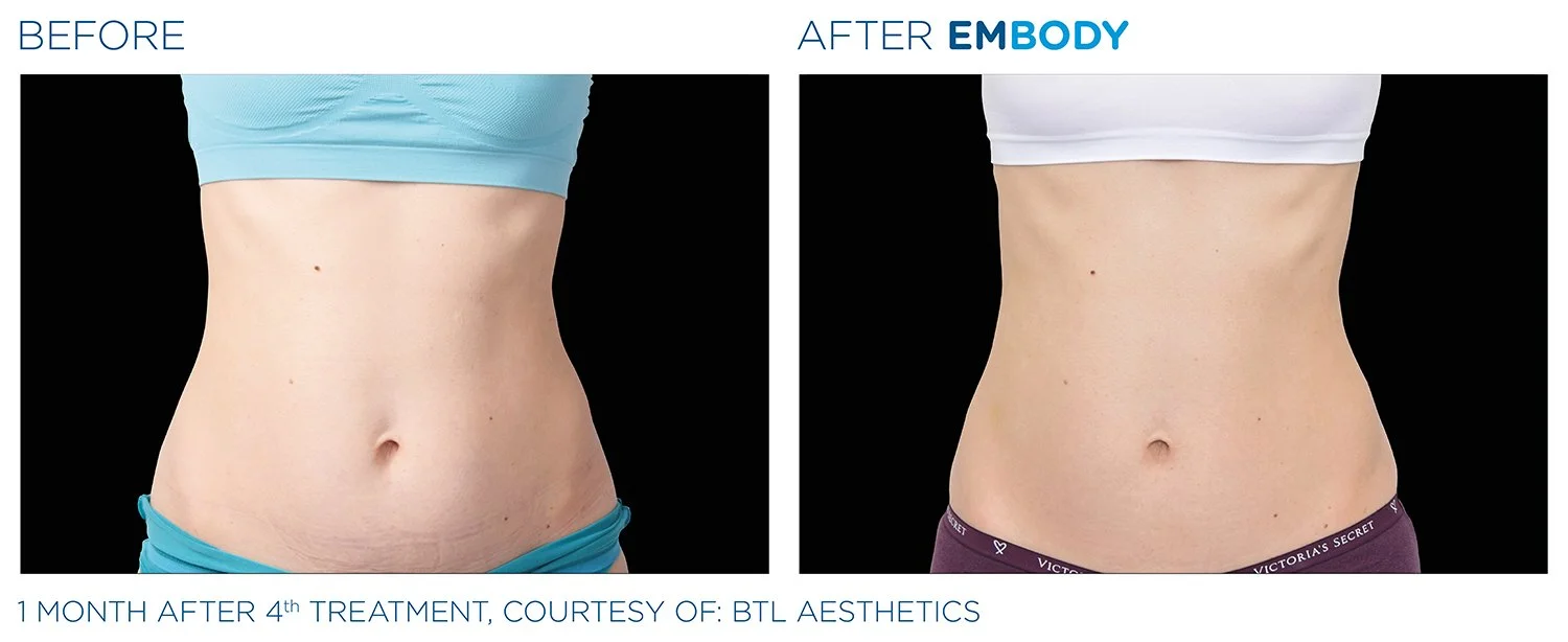 EMBODY Abdomen Before and After Results | JBH Aesthetics Camden
