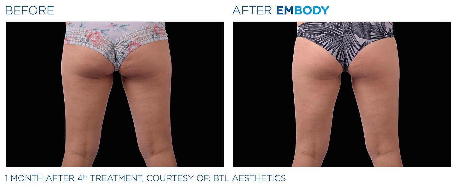 EMBODY Buttocks Before and After Results | JBH Aesthetics Camden