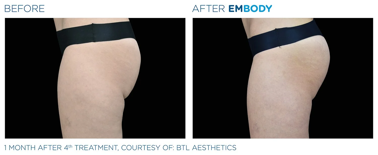 EMBODY Buttocks Before and After Results | JBH Aesthetics Camden