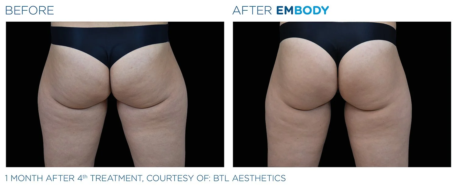 EMBODY Buttocks Before and After Results | JBH Aesthetics Camden