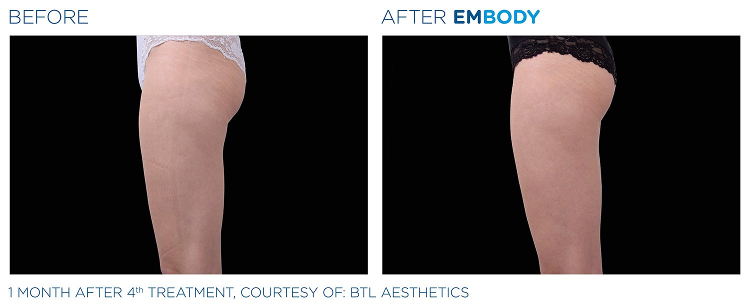 EMBODY Buttocks Before and After Results | JBH Aesthetics Camden
