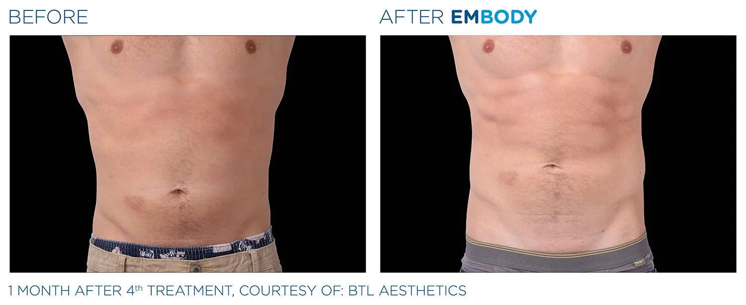 EMBODY Abdomen Before and After Results | JBH Aesthetics Camden