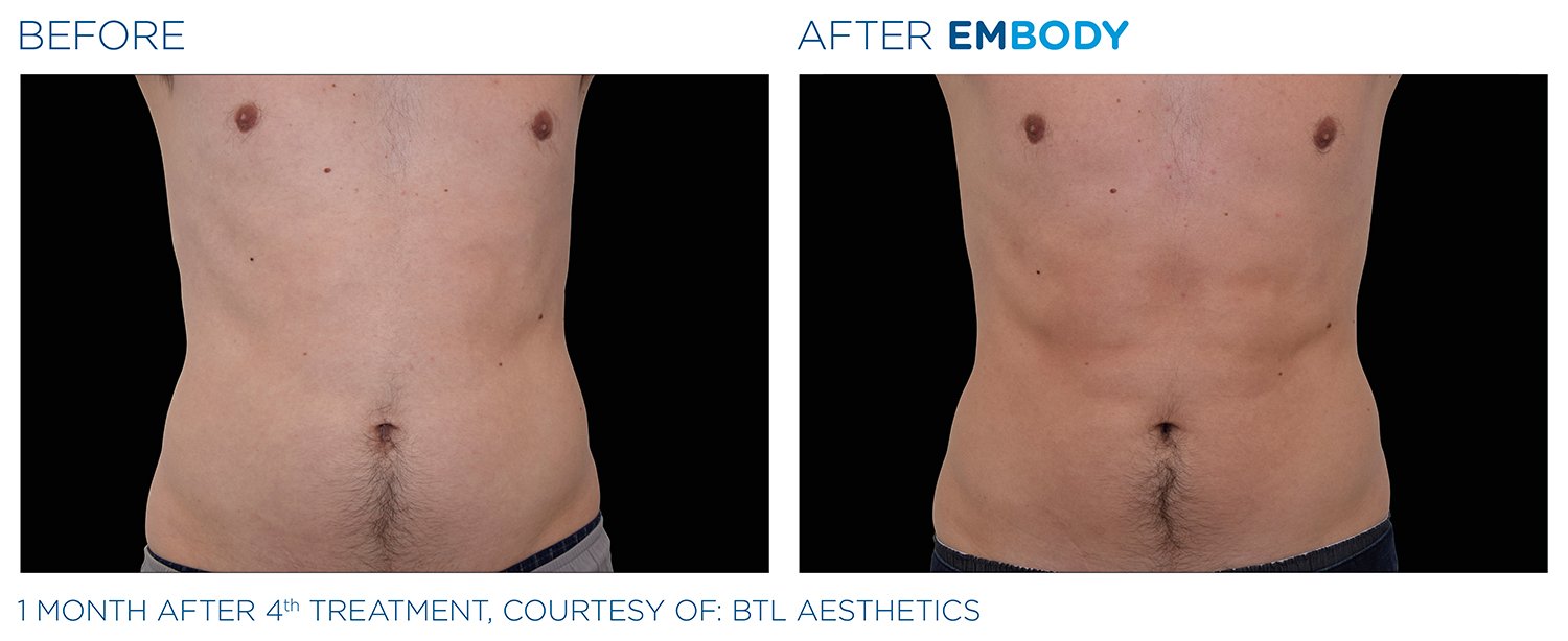 EMBODY Abdomen Before and After Results | JBH Aesthetics Camden