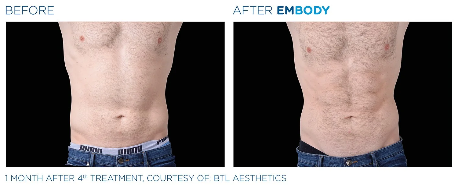 EMBODY Abdomen Before and After Results | JBH Aesthetics Camden