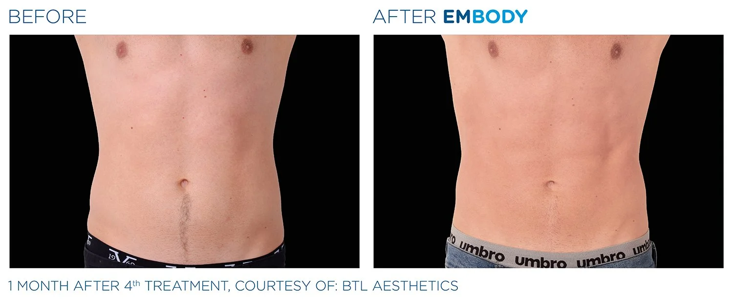 EMBODY Abdomen Before and After Results | JBH Aesthetics Camden