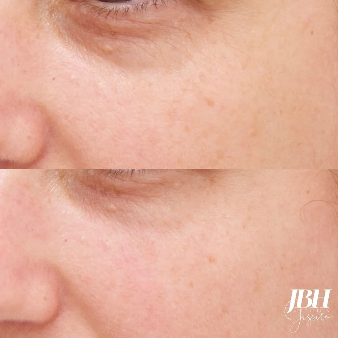Before and After REJURAN® - Results by JBH Aesthetics Camden