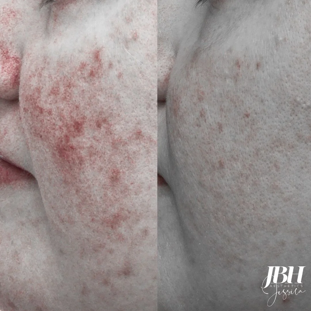 Redness Before and After - Results by JBH Aesthetics Camden (Copy)