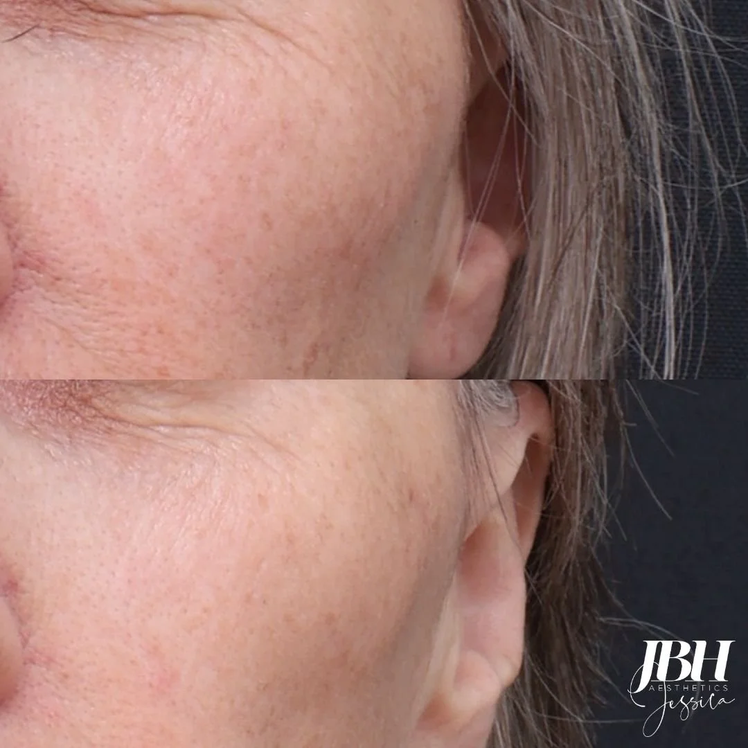 Before and After Pigmentation Removal Treatments - Results by JBH Aesthetics Camden