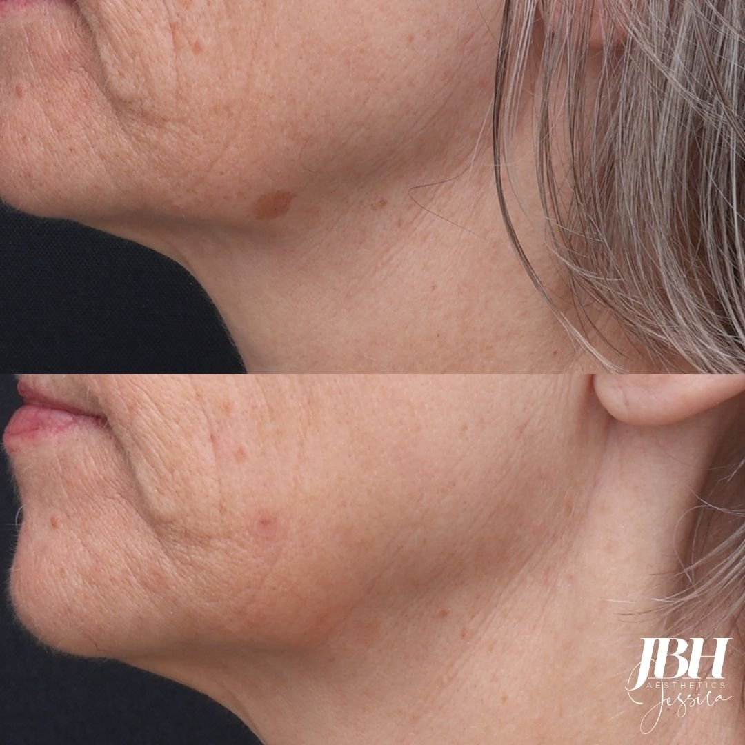 Before and After Pigmentation Removal Treatments - Results by JBH Aesthetics Camden