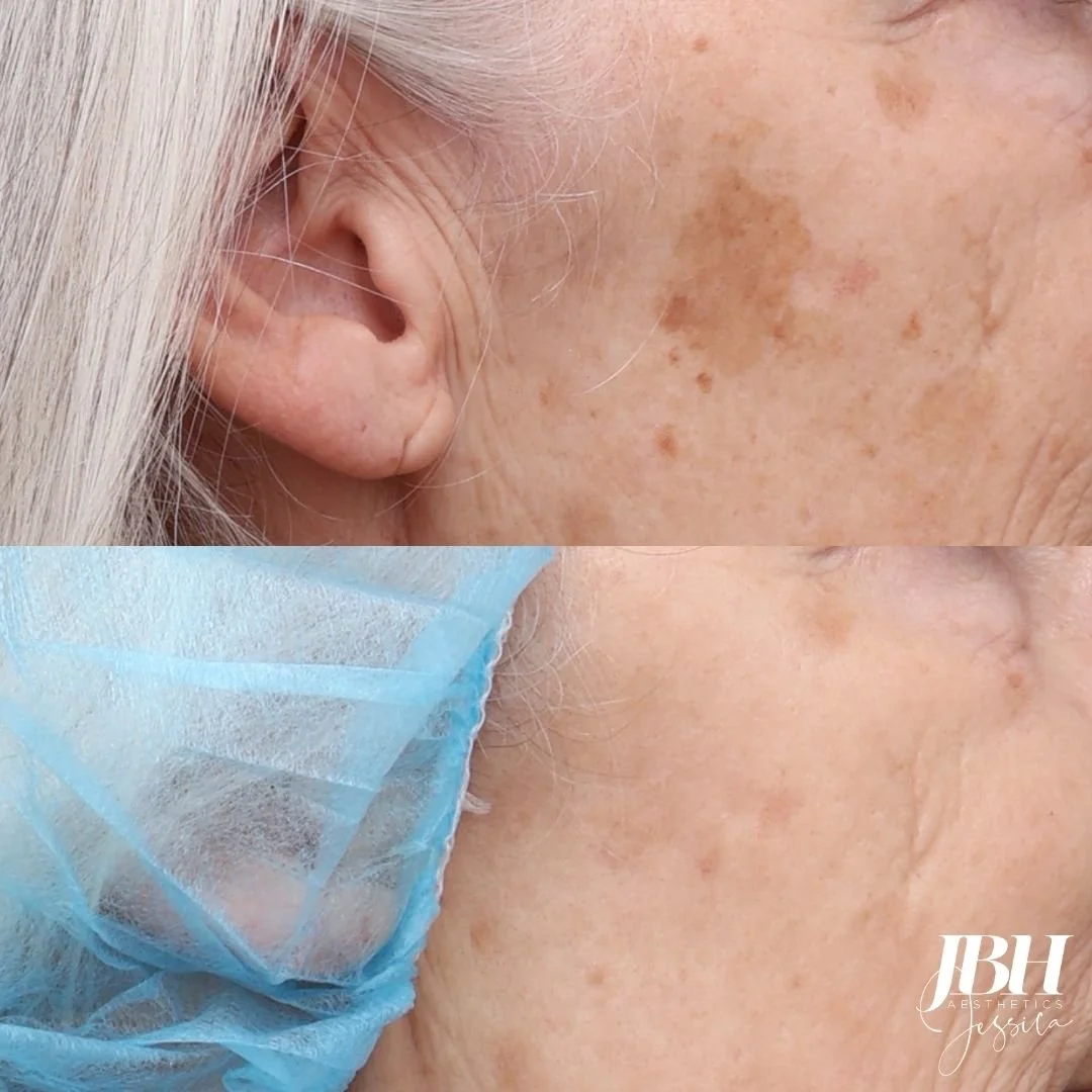 Before and After Pigmentation Removal Treatments - Results by JBH Aesthetics Camden
