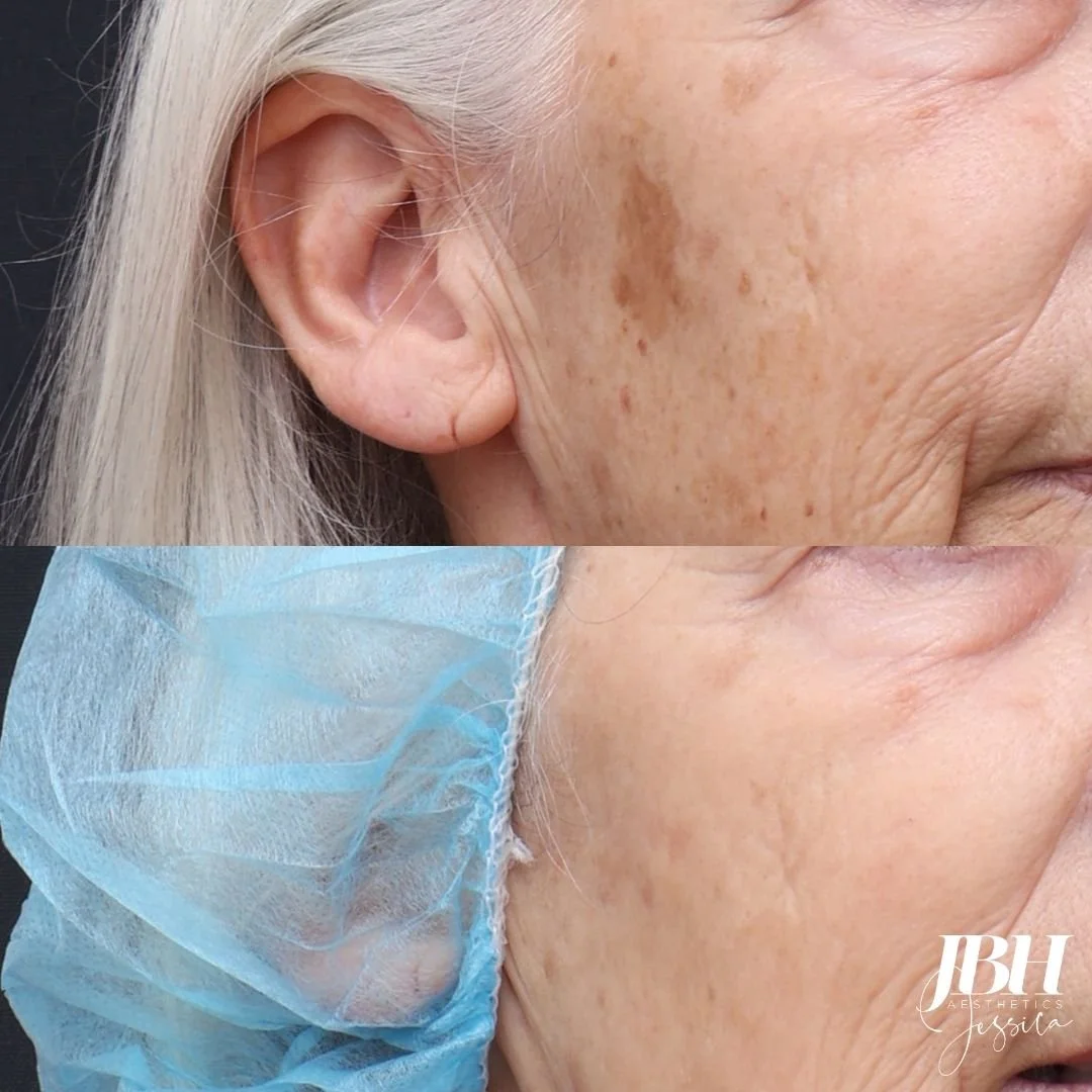 Before and After Pigmentation Removal Treatments - Results by JBH Aesthetics Camden